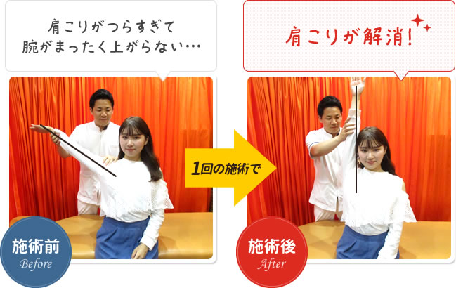 肩こりがひどくて腕が全くあがらないのが、1回の施術での肩こりが解消